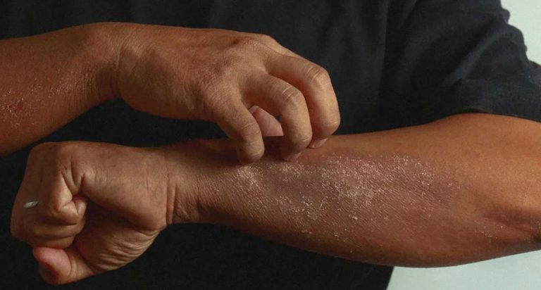 Eczéma et dermatite sur peau noire : apaiser durablement