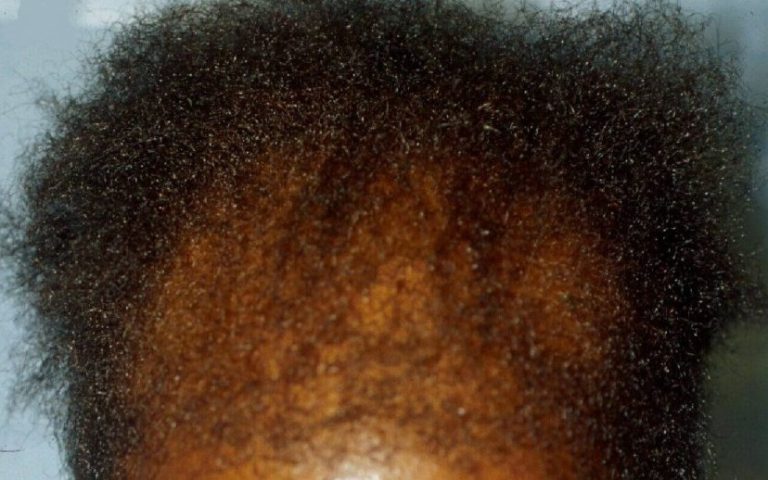 Alopécie de traction : prévenir la chute liée aux tresses