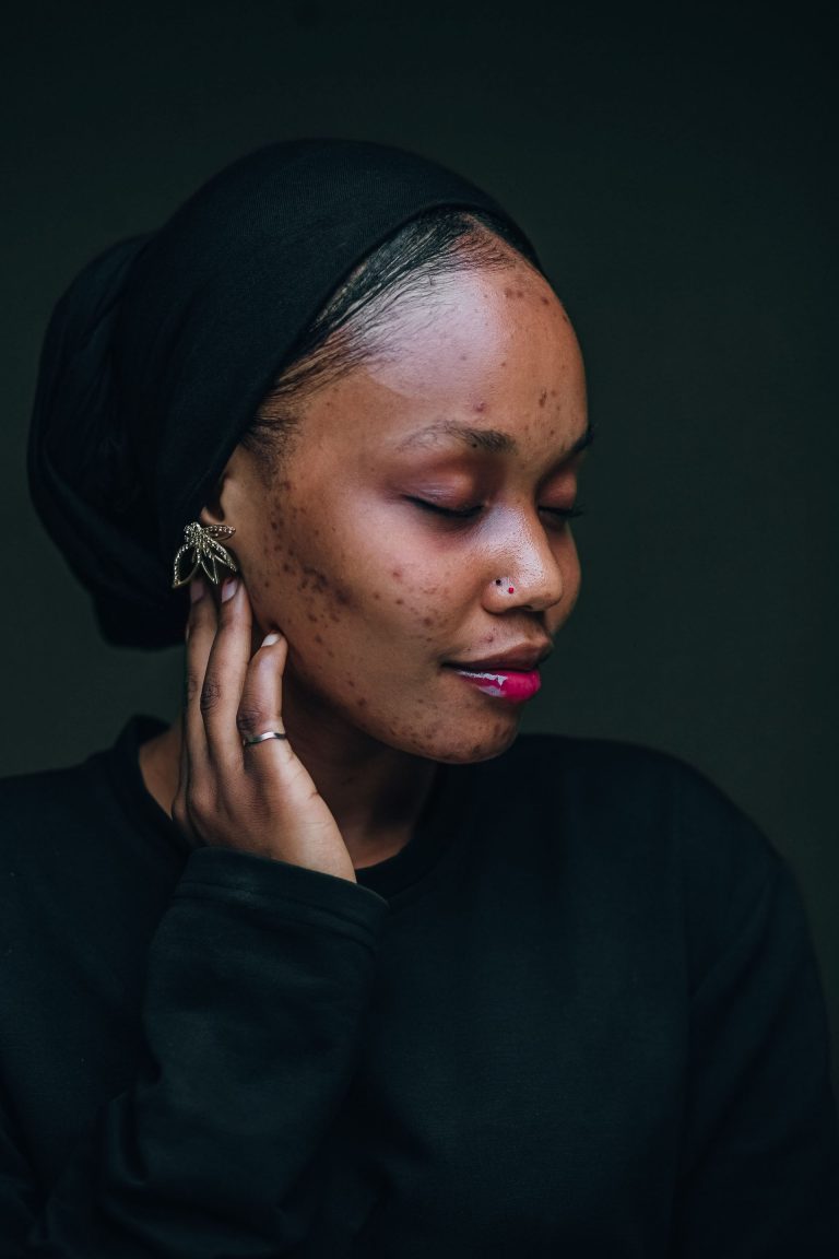 Hyperpigmentation sur peau noire : causes et solutions