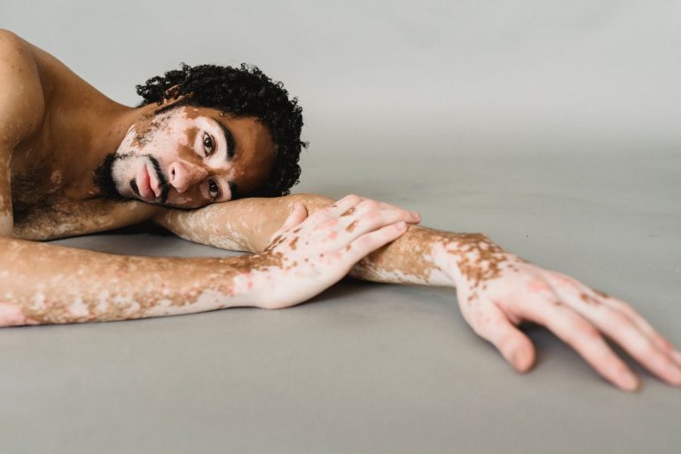Dépigmentation volontaire : dangers du bleaching et alternatives