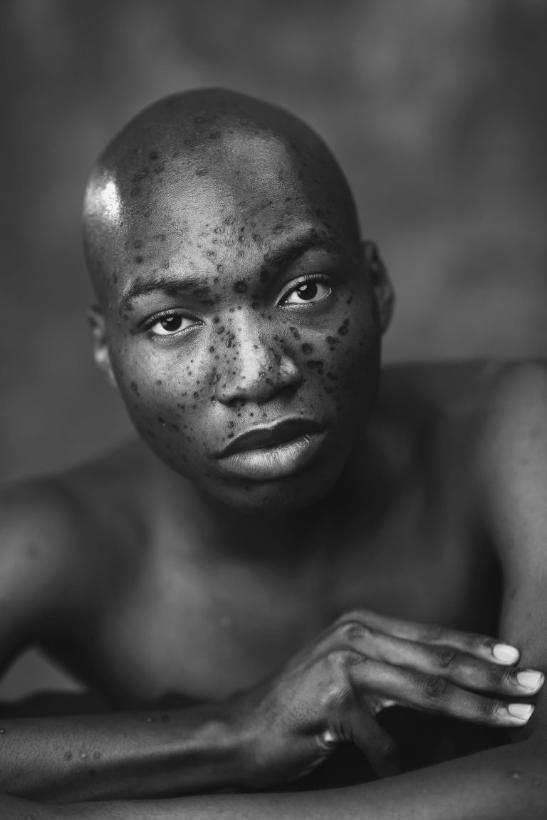 Soins anti-taches naturels pour peau noire qui marchent