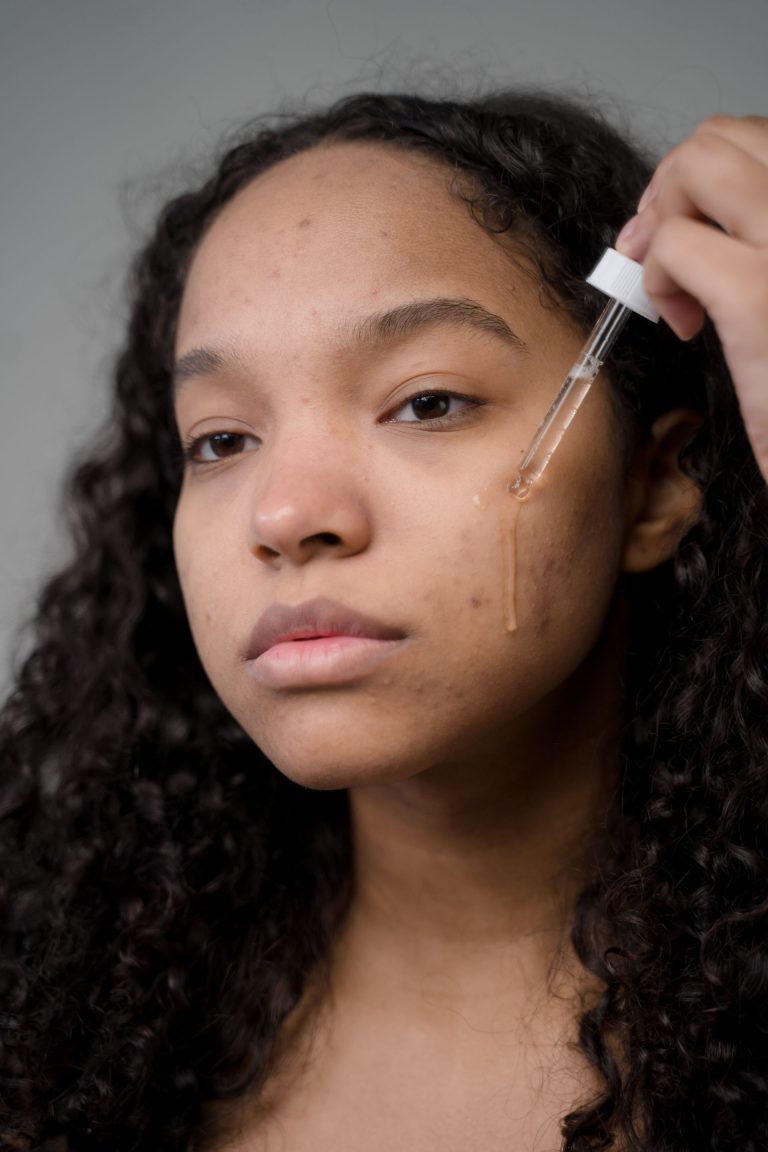 Acné sur peau noire : traiter sans aggraver les taches
